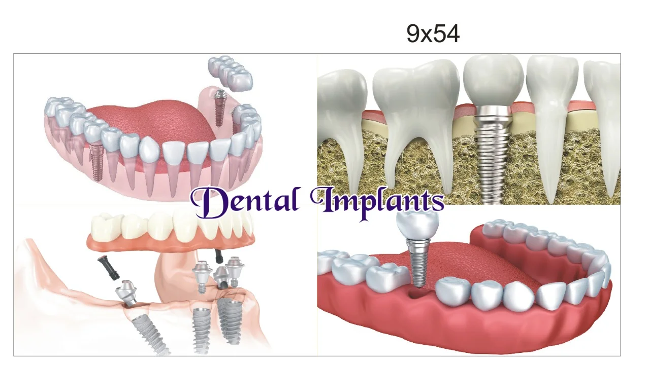 Dental Implants