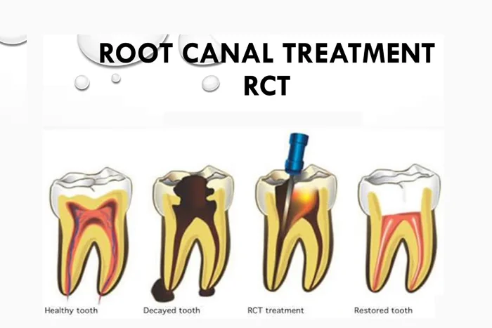 Root Canal Treatment