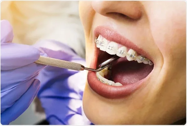 Dental Braces
