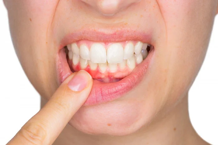 Gum Surgery